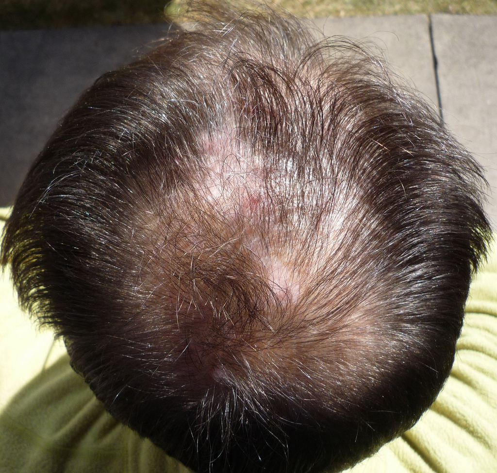 James bald spot six weeks by Ambernectar 13 bald spot photo