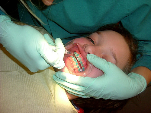 Brackets by Aine D blue teeth photo